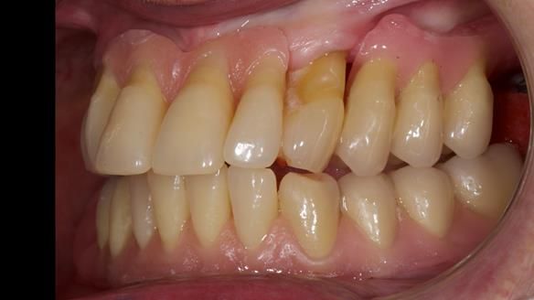 Finlay's Newsletter 59 Ultra hard partial dentures made for Gill