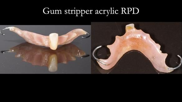 Newsletter 86 Peter the Architect — precision removable partial dentures case study