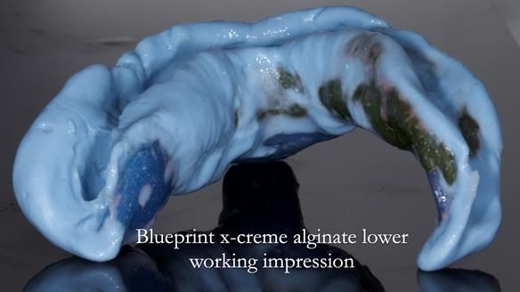 Newsletter 55 Provision of metal based partial dentures for Zephyrine with a repaired cleft lip and palate