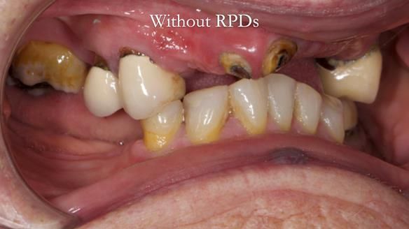 Eileen's transformation with upper and lower RPDs of Scandinavian hygienic design FULL PROTOCOL