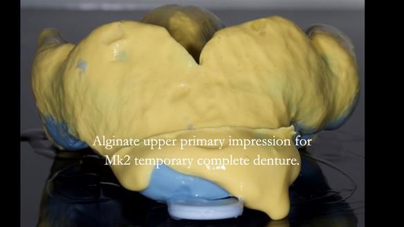 Newsletter 77: Jeremy’s case – immediate complete upper denture