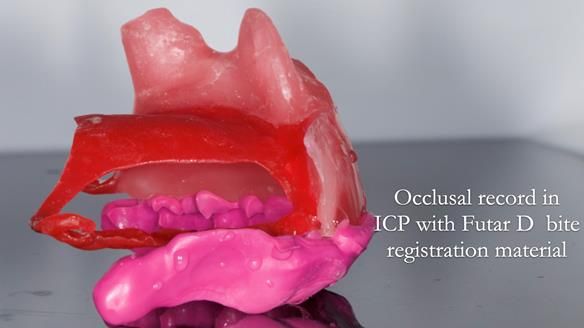 Upper metal base partial denture/occlusal stabilisation splint/obturator - full protocol