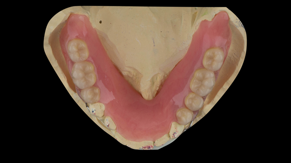 Figure 35 Mandibular immediate acrylic based partial denture. Lingual surfaces extended to the mylohyoid line avoiding lingual frenum. Schottlander Enigmalife teeth