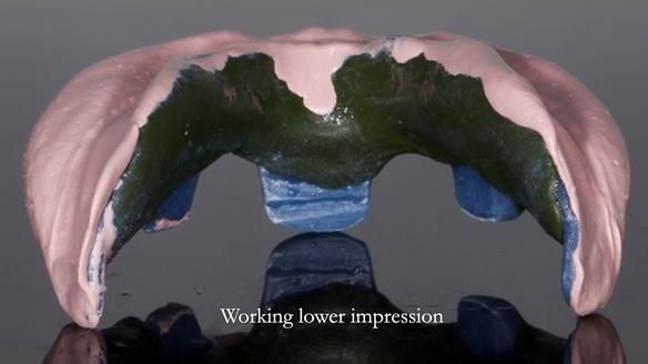 Newsletter 83: Sheila’s Complete Denture Success