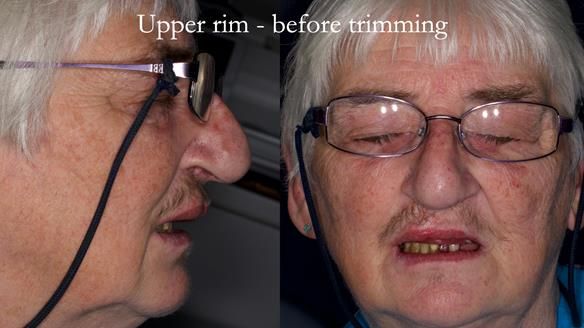 Newsletter 55 Provision of metal based partial dentures for Zephyrine with a repaired cleft lip and palate