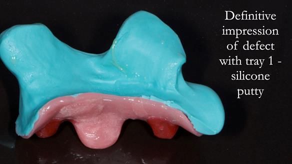 Upper metal base partial denture/occlusal stabilisation splint/obturator - full protocol