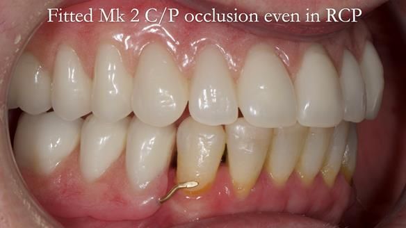 Newsletter 52 Managing Jo’s failing dentition with extractions and Mk 1/Mk 2 complete upper dentures and lower partial dentures FULL PROTOCOL
