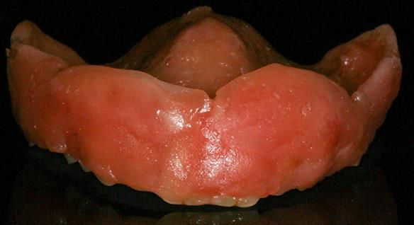 Figure 55 Wax covering the labial aspect of the Mk 1 upper front teeth preventing run of Ufi Gel into the interdental embrasures. This helps speed up clean up of labial surface of the denture. The wax can be pealed off when the Ufi Gel is hard enough.