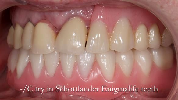 Newsletter 44 - extreme removable prosthodontics – engineering a super-strong and ultra-thin over denture