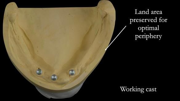 Preservation of a land area on the cast allows correct shaping of the polished surfaces