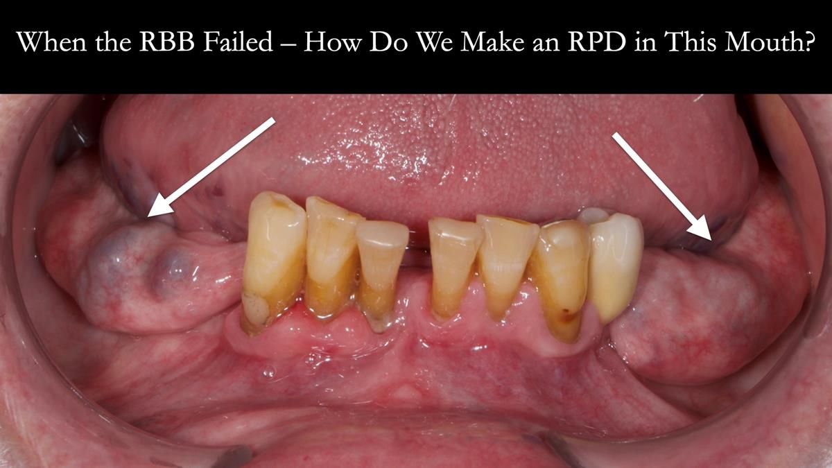 Newsletter 87 – Father Peter: A Partial Denture that needed Minor Miracle