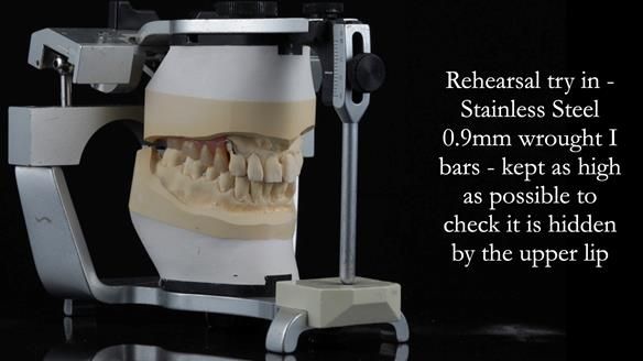 Newsletter 56 showing the making and fitting of a bilateral free end saddle upper removable partial denture (RPD) for patient with pemphigus