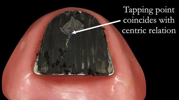 The tip of the triangle is the most reproducible jaw position for an edentulous patient - centric relation Occasionally I verify with a tapping point using articulating paper if the triangle tip is not quite clear.