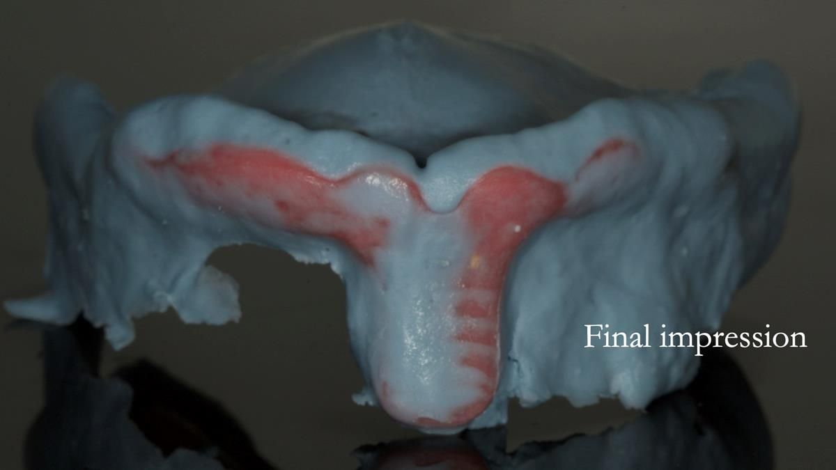Newsletter 87 – Father Peter: A Partial Denture that needed Minor Miracle