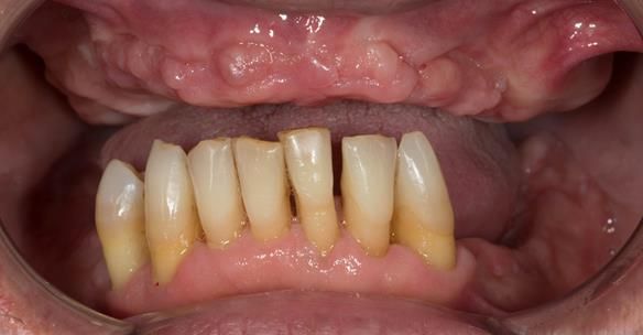 Figure 115 12 months after removal of failing teeth. During this time Mk 1 immediate dentures were fitted, periodontal therapy (including periodontal flap surgery) was provided 