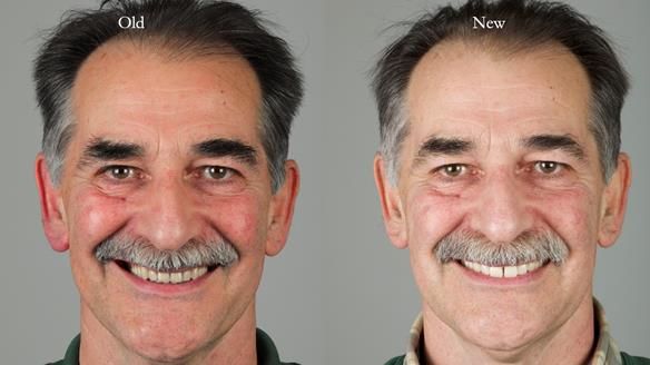 Newsletter 78: What do Clark Gable and a Locator® overdenture have in common?