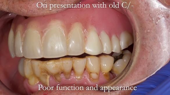 Newsletter 54 case presentation upper complete denture and lower Scandinavian designed hygienic partial denture for David