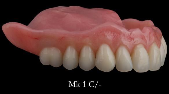 Newsletter 52 Managing Jo’s failing dentition with extractions and Mk 1/Mk 2 complete upper dentures and lower partial dentures FULL PROTOCOL