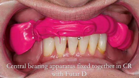Newsletter 52 Managing Jo’s failing dentition with extractions and Mk 1/Mk 2 complete upper dentures and lower partial dentures FULL PROTOCOL