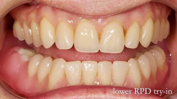 Newsletter 82 Mary - A complete upper and a one-tooth gasket denture