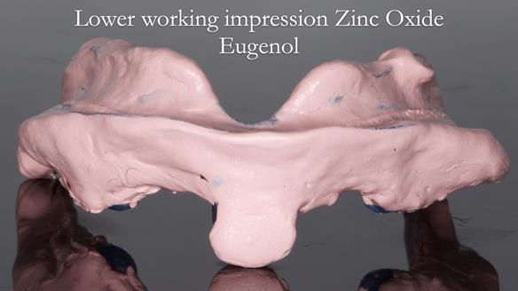 Newsletter 80 - Gordon’s dentures: the one case in 1,000 where my technique failed