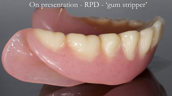 Finlay's Newsletter 59 Ultra hard partial dentures made for Gill