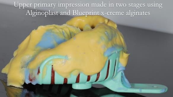 Newsletter 55 Provision of metal based partial dentures for Zephyrine with a repaired cleft lip and palate