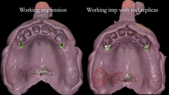 Newsletter 76: Jackie’s case – Telescopic overdenture & precision RPD (the tricky truth!)