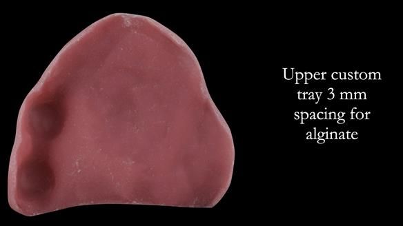 Solving Linda’s Failed “All on 4” implant bridges - full protocol Newsletter 42