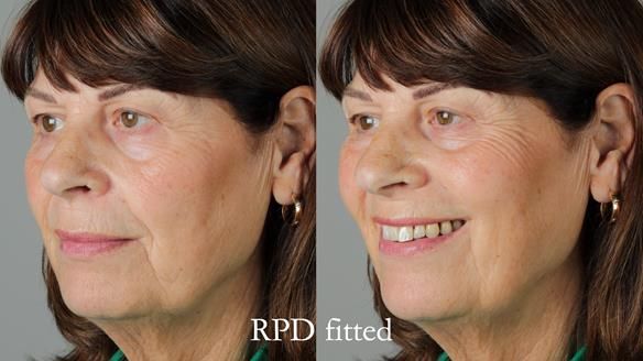 Newsletter 56 showing the making and fitting of a bilateral free end saddle upper removable partial denture (RPD) for patient with pemphigus