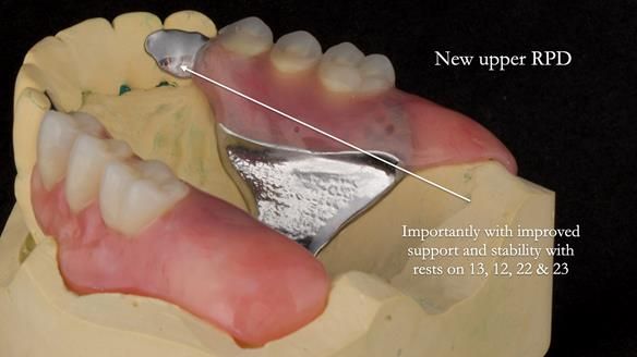 Newsletter 76: Jackie’s case – Telescopic overdenture & precision RPD (the tricky truth!)