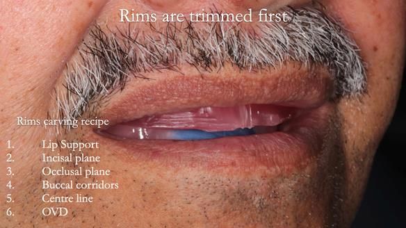 Finlay's Newsletter 62 provision of extractions and metal based complete dentures for Rafique