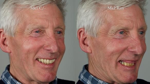 Newsletter 77: Jeremy’s case – immediate complete upper denture