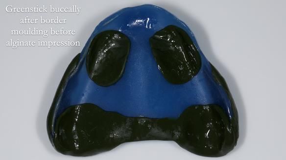 Newsletter 80 - Gordon’s dentures: the one case in 1,000 where my technique failed