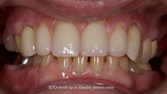 Newsletter 81 - Pam’s Story — how a partial denture changed her life (+ live walkthrough this Thursday)