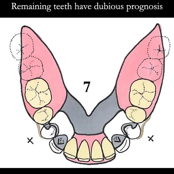 Universal Scandinavian partial denture designs