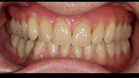 Newsletter 82 Mary - A complete upper and a one-tooth gasket denture