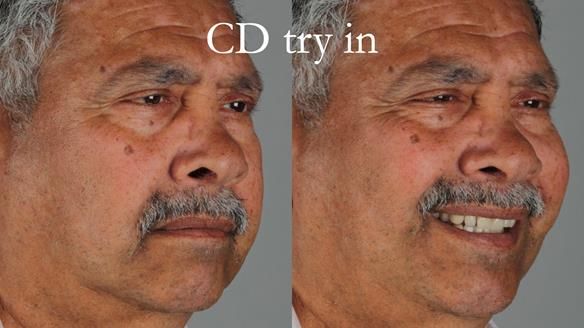 Finlay's Newsletter 62 provision of extractions and metal based complete dentures for Rafique