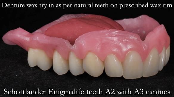 Finlay's Newsletter 58 Gasket upper partial denture for Zoe