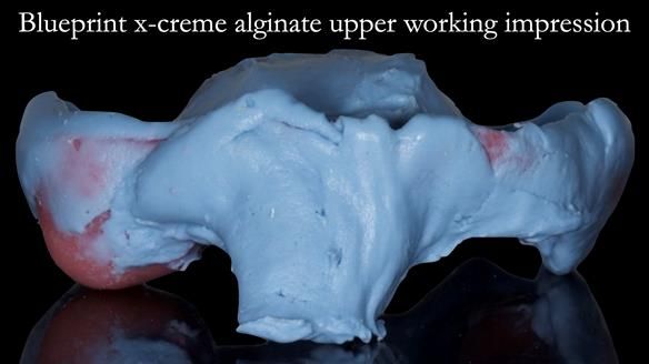 Newsletter 52 Managing Jo’s failing dentition with extractions and Mk 1/Mk 2 complete upper dentures and lower partial dentures FULL PROTOCOL