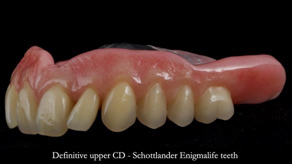 Newsletter 82 Mary - A complete upper and a one-tooth gasket denture
