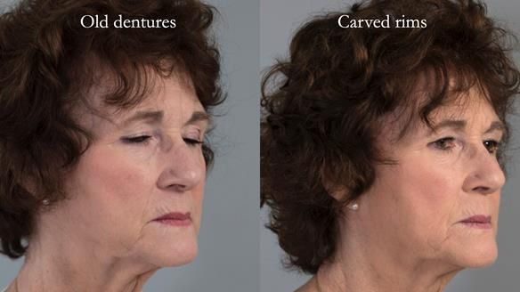 Newsletter 75: Marion’s case - Step-by-step complete denture workflow