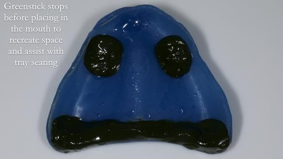 Newsletter 80 - Gordon’s dentures: the one case in 1,000 where my technique failed
