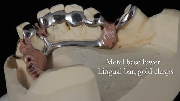 Newsletter 55 Provision of metal based partial dentures for Zephyrine with a repaired cleft lip and palate