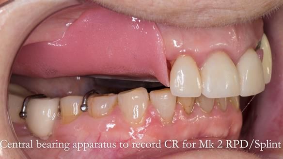 Newsletter 51 Managing Anne’s failing dentition with distal extension base RPD/Splint FULL PROTOCOL
