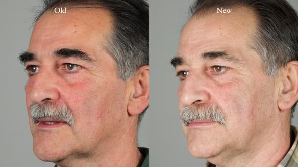 Newsletter 78: What do Clark Gable and a Locator® overdenture have in common?