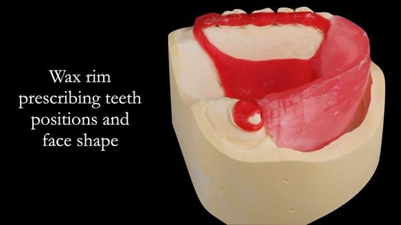 Upper metal base partial denture/occlusal stabilisation splint/obturator - full protocol