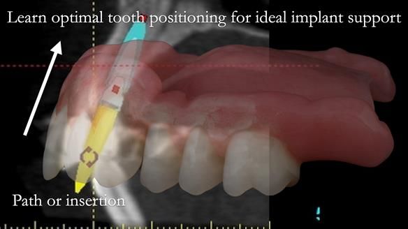 Finlay's Newsletter 59 Ultra hard partial dentures made for Gill
