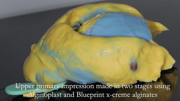 Finlay's Newsletter 59 Ultra hard partial dentures made for Gill