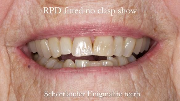 Finlay's Newsletter 60 Sylvia's upper Kennedy Class 2 Mod 1 metal based upper RPD